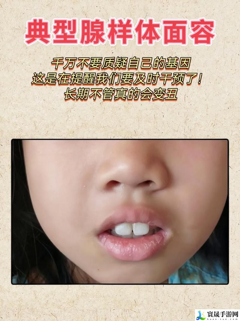 小嘴无力合拢红肿外翻图片